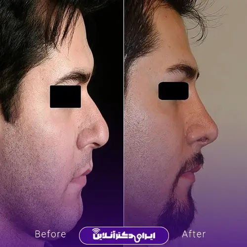 نمونه کار قبل و بعد عمل بینی گوشتی آقا توسط دکتر محمدرضا سلیمی در شهر کرج