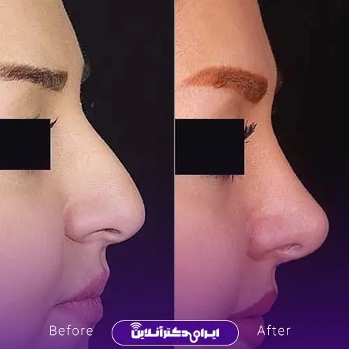 نمونه کار نیم‌رخ جراحی بینی گوشتی خانم‌ها توسط دکتر محمدرضا سلیمی