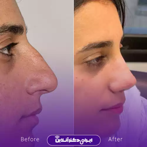 قبل و بعد عمل بینی استخوانی در اصفهان؛ کاهش برجستگی پشت بینی و بالاتر رفتن نوک بینی، نمونه کار دکتر نفیسه السادات محمودی