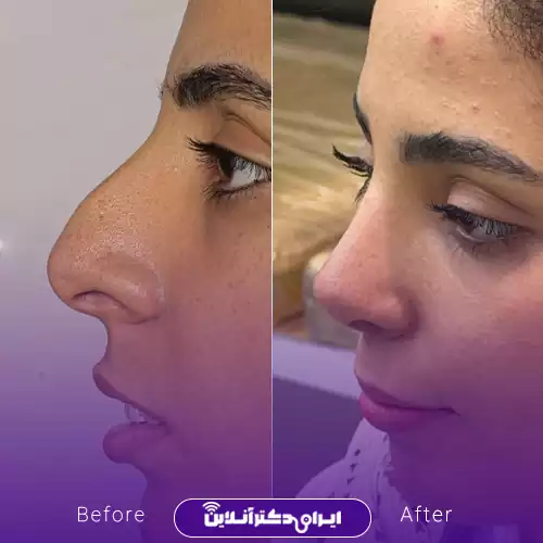 قبل و بعد عمل بینی استخوانی در اصفهان؛ حذف قوز بزرگ و اصلاح خط نیم‌رخ، نمونه کار دکتر نفیسه السادات محمودی