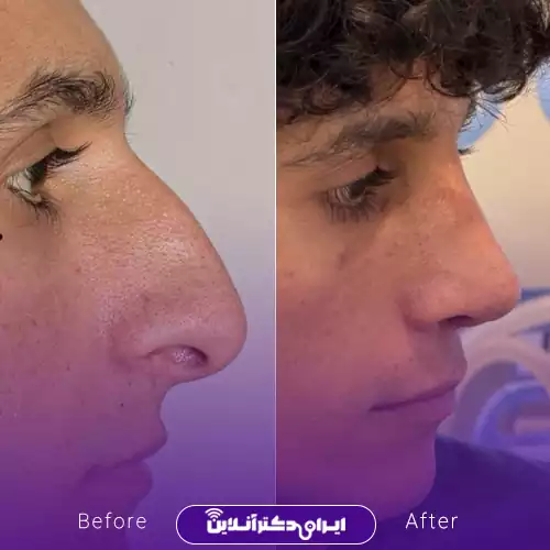 قبل و بعد جراحی بینی استخوانی در اصفهان؛ نیم‌رخ بینی پس از اصلاح قوز، دکتر نفیسه السادات محمودی