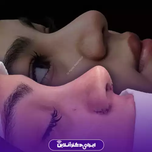 نمونه کار عمل بینی دکتر پریسا نظرپور 2