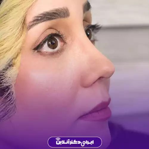 نمونه کار عمل بینی دکتر پریسا نظرپور 3