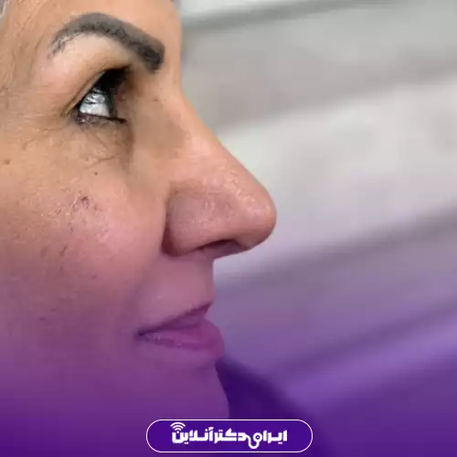 نمونه کار عمل بینی دکتر پریسا نظرپور 4