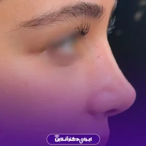 نمونه عمل بینی دکتر پگاه فروغی 2