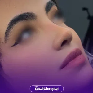 نمونه عمل بینی دکتر پگاه فروغی 4
