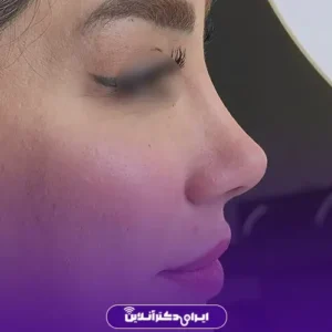 نمونه عمل بینی دکتر پگاه فروغی 6