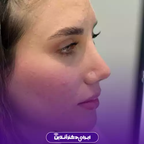 نمونه قبل و بعد عمل بینی طبیعی دکتر رحیمی پور در تهران 2