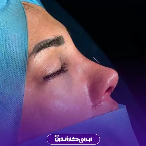 نمونه قبل و بعد عمل بینی طبیعی دکتر رحیمی پور در تهران 3