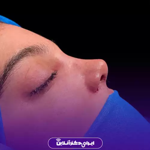نمونه قبل و بعد عمل بینی طبیعی دکتر رحیمی پور در تهران 4