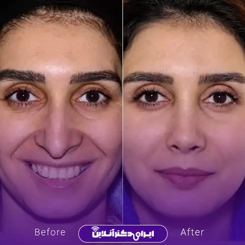 نمونه کار قبل و بعد جراحی طبیعی بینی دکتر راستی 1