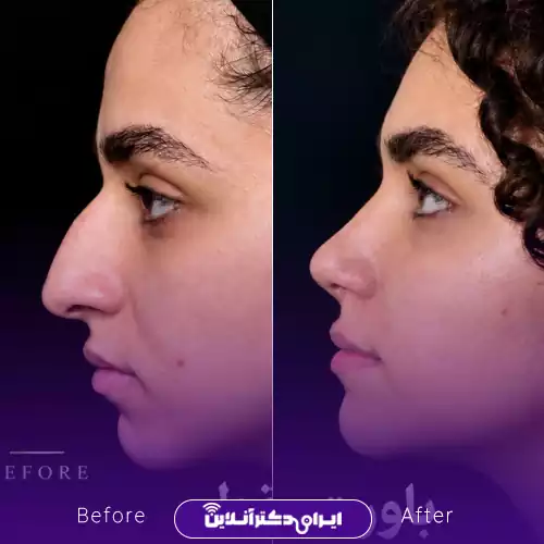 نمونه کار قبل و بعد جراحی طبیعی بینی دکتر راستی 2