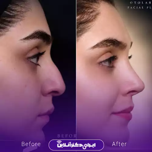 نمونه کار قبل و بعد جراحی طبیعی بینی دکتر راستی 3
