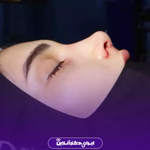 نمونه کار قبل و بعد جراحی طبیعی بینی دکتر راستی 4