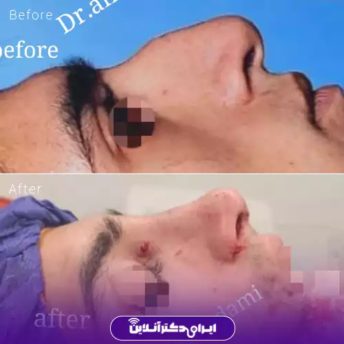 قبل و بعد عمل بینی استخوانی در اصفهان؛ عکس نیم‌رخ پیش از جراحی کنار صورت بیمار در اتاق عمل، دکتر سید علیرضا خدامی