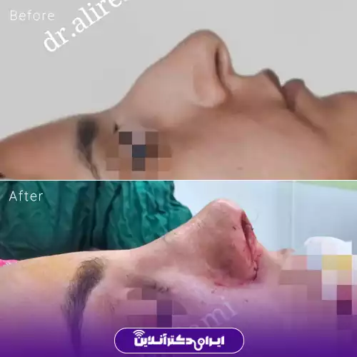 قبل و بعد عمل بینی استخوانی در اصفهان؛ اصلاح قوز و خط پشت بینی، نمونه کار دکتر سید علیرضا خدامی