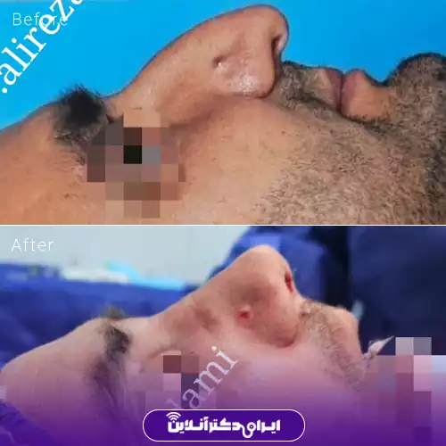 قبل و بعد عمل بینی استخوانی در اصفهان؛ تغییر نیم‌رخ بینی بلافاصله پس از جراحی، نمونه کار دکتر سید علیرضا خدامی