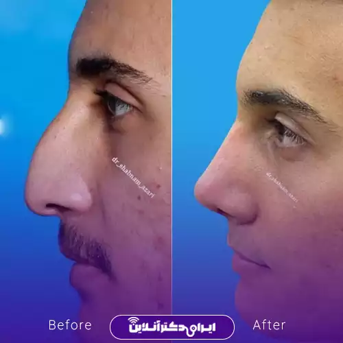 قبل و بعد عمل بینی استخوانی در اصفهان؛ حذف قوز بزرگ و کوتاه‌تر شدن بینی در نیم‌رخ، نمونه کار دکتر شبنم آذری