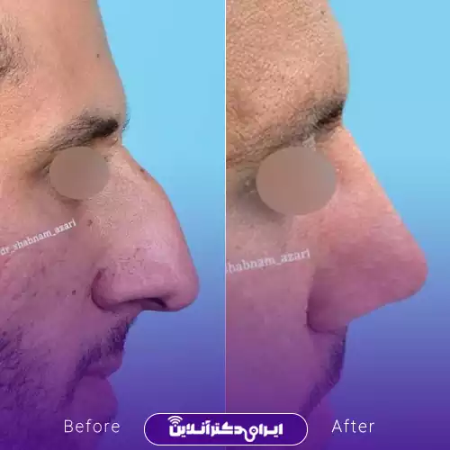 قبل و بعد عمل بینی استخوانی در اصفهان؛ کاهش برجستگی پشت بینی و اصلاح خط نیم‌رخ، نمونه کار دکتر شبنم آذری