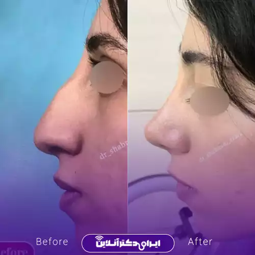 قبل و بعد عمل بینی استخوانی در اصفهان؛ اصلاح قوز و بالاتر رفتن نوک بینی در نیم‌رخ، نمونه کار دکتر شبنم آذری