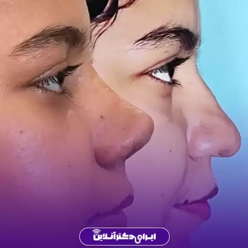 نمونه کار قبل و بعد جراحی بینی گوشتی نیم‌رخ توسط دکتر شایسته شهمیرزادی در کرج