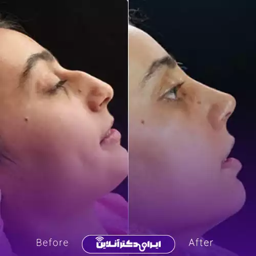 قبل و بعد عمل بینی استخوانی در اصفهان؛ اصلاح قوز و بالاتر رفتن نوک بینی در نیم‌رخ، نمونه کار دکتر سهراب براتی