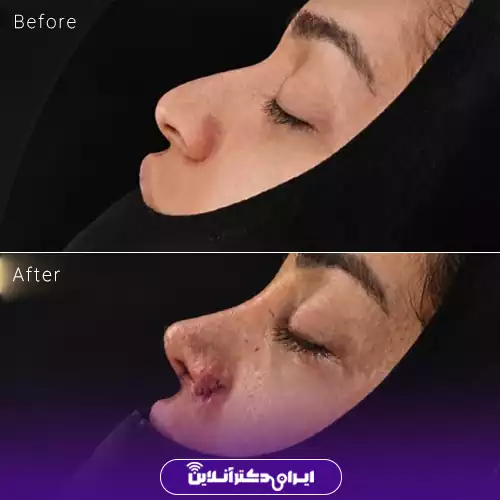 قبل و بعد عمل بینی استخوانی در اصفهان؛ تغییر نیم‌رخ بینی در نخستین روزهای پس از جراحی، نمونه کار دکتر سهراب براتی