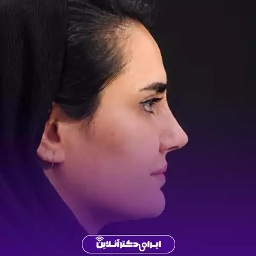 نیم‌رخ بینی پس از عمل بینی استخوانی در اصفهان، نمونه کار دکتر سهراب براتی