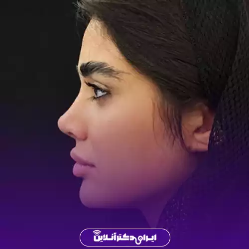 نمای نیم‌رخ بینی پس از جراحی بینی استخوانی در اصفهان، نمونه کار دکتر سهراب براتی