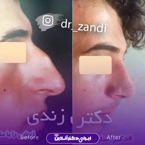 قبل و بعد عمل بینی استخوانی در اصفهان؛ اصلاح قوز و کاهش برجستگی پشت بینی در نیم‌رخ، نمونه کار دکتر سلیمان زندی