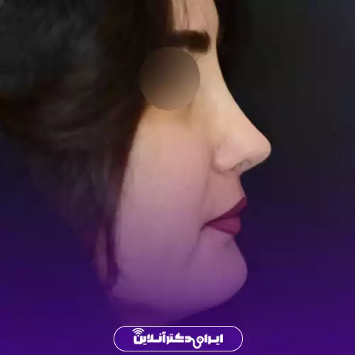 انواع عمل بینی 45 مدل بینی اروپایی (فرانسوی)
