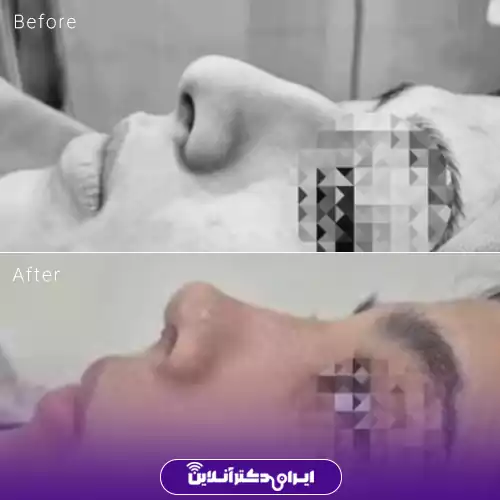 نمونه کار عمل بینی دکتر سونا سپاهی 1