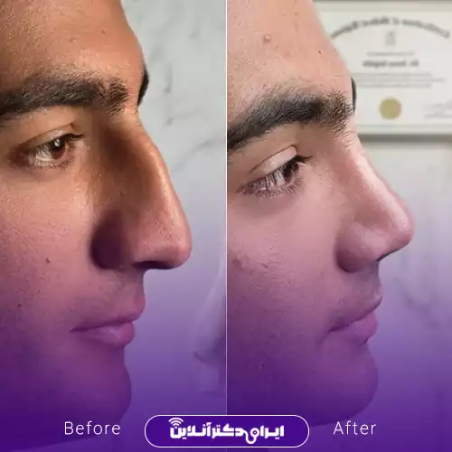 نمونه کار عمل بینی دکتر سونا سپاهی 2