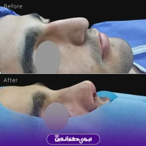 نمونه کار عمل بینی دکتر حمیدرضا فرجاد 1