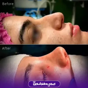 نمونه کار عمل بینی دکتر حمیدرضا فرجاد 2