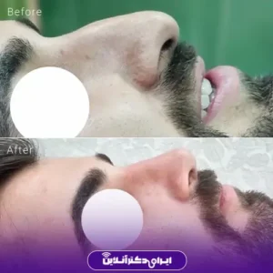نمونه کار عمل بینی دکتر حمیدرضا فرجاد 3