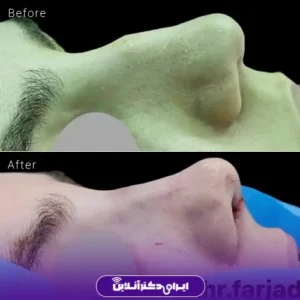 نمونه کار عمل بینی دکتر حمیدرضا فرجاد 4