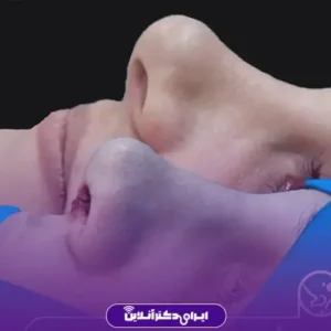 نمونه کار عمل بینی دکتر حمیدرضا فرجاد 7