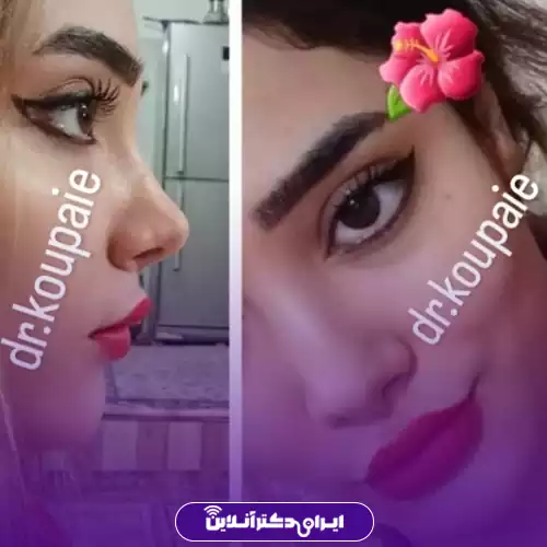 نمونه کار نیم‌رخ جراحی بینی گوشتی در کرج توسط دکتر محمد اسلامیان کوپایی