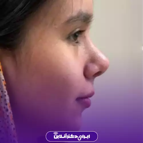 نمونه کار نیم‌رخ جراحی بینی گوشتی خانم توسط دکتر نجمه زندی‌پور