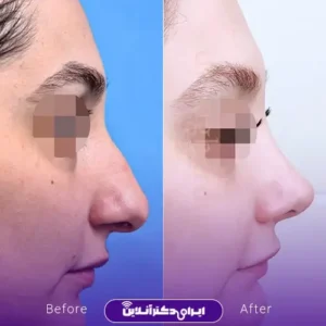 نمونه کار عمل بینی دکتر رضا وقردوست 1
