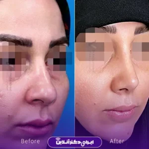 نمونه کار عمل بینی دکتر رضا وقردوست 10