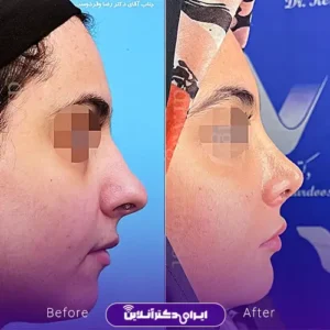نمونه کار عمل بینی دکتر رضا وقردوست 2