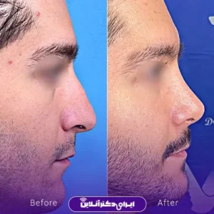 نمونه کار عمل بینی دکتر رضا وقردوست 3