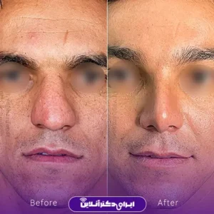 نمونه کار عمل بینی دکتر رضا وقردوست 5