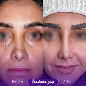 نمونه کار عمل بینی دکتر رضا وقردوست 8