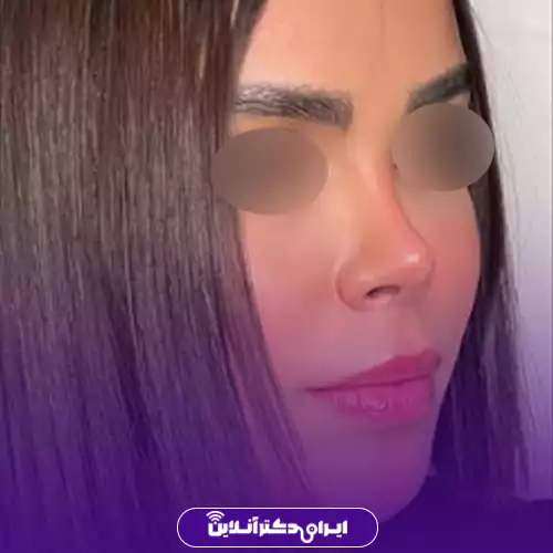انواع عمل بینی 40 مدل بینی خوکی