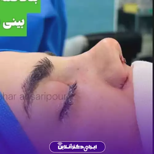 نمونه کار نیم‌رخ جراحی بینی گوشتی در کرج توسط دکتر سحر انصاری‌پور، متخصص ENT