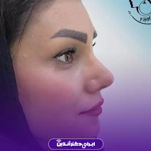 نمونه کار عمل بینی گوشتی خانم‌ها در شهر کرج توسط دکتر سحر انصاری‌پور، جراح و متخصص ENT