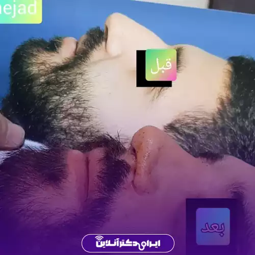 نمونه کار قبل و بعد عمل بینی گوشتی توسط دکتر علیرضا خاک‌نژاد در کرج